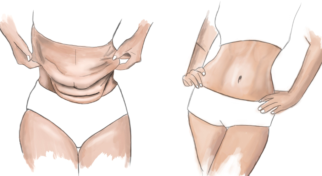 Abdominoplastie à Casablanca : Retrouvez un Ventre Plat