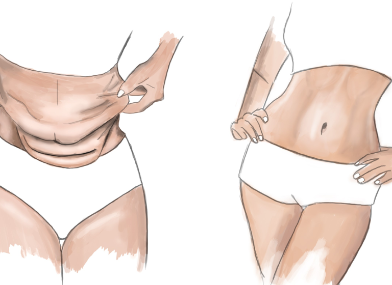 Abdominoplastie à Casablanca