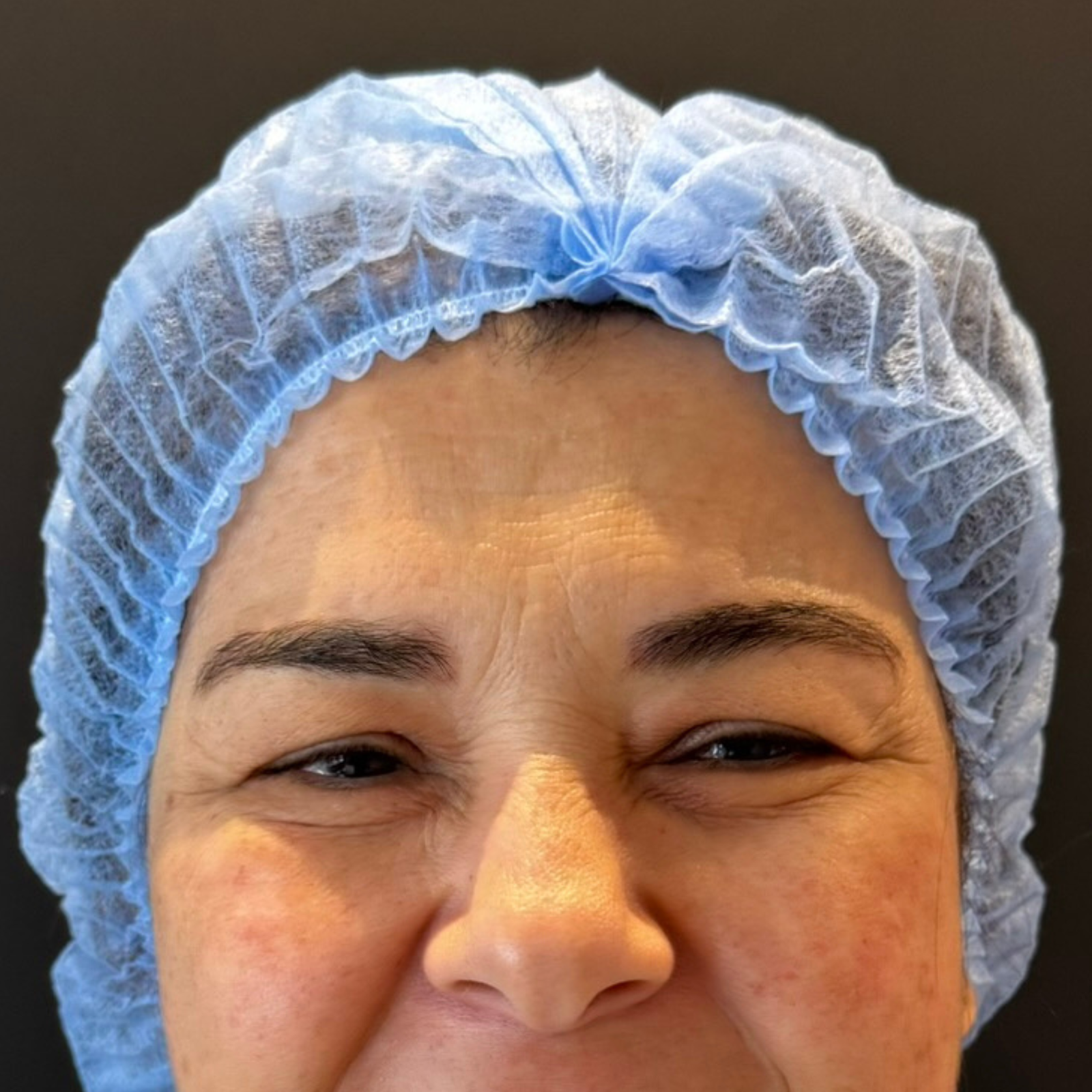 Blepharoplastie avant Blepharoplastie avant