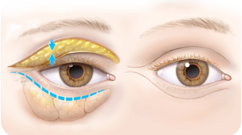 Blépharoplastie à Casablanca : Un Regard Jeune & Naturel