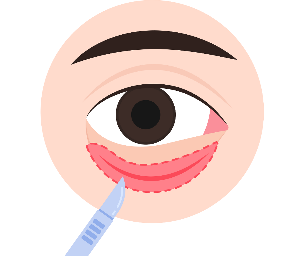 hc aesthetics-cabinet blepharoplastie inferieur