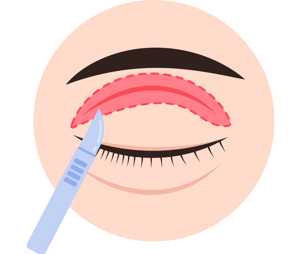 hc aesthetics-cabinet blepharoplastie superieur