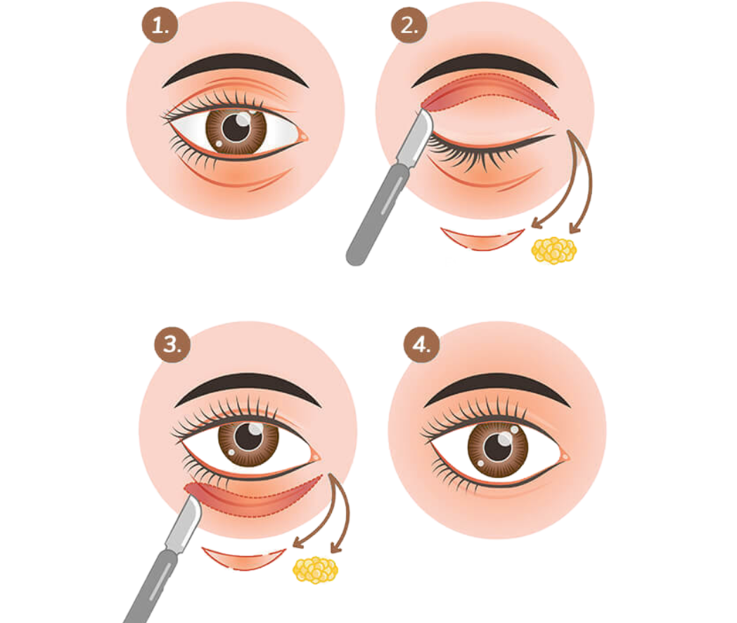 hc aesthetics-cabinet -les etapes de la blepharoplastie