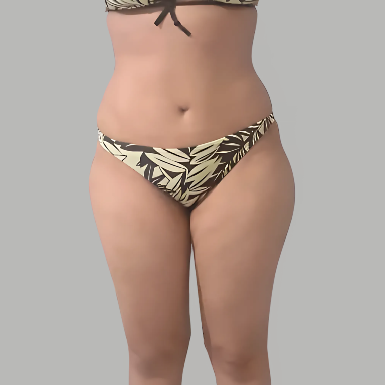 hcaesthetics- apres lipoabdominoplastie
