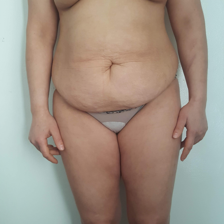 hcaesthetics- Avant abdominoplastie