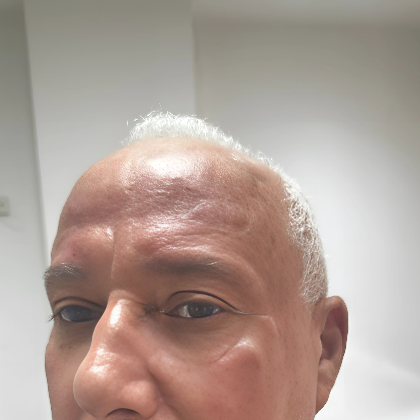 hcaesthetics- avant apres blepharoplastie inferieur (1) hcaesthetics- avant apres blepharoplastie inferieur