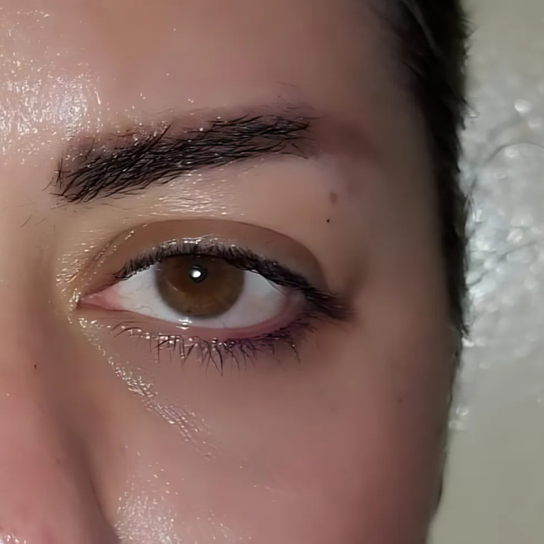 Chirurgie des paupières HC Aesthetics hcaesthetics- avant apres- blepharoplastie inferieur (1!1)