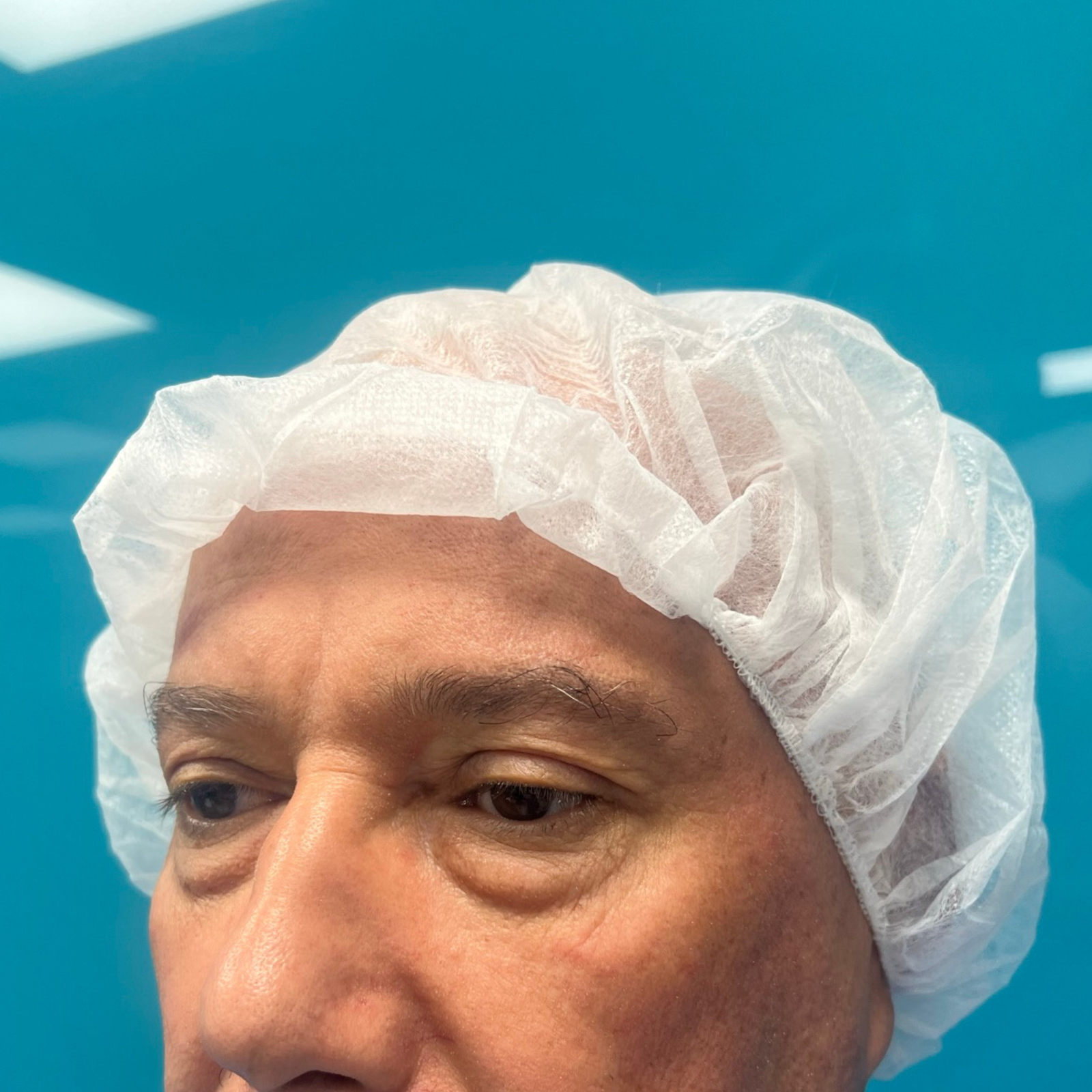hcaesthetics- avant apres blepharoplastie inferieur hcaesthetics- avant apres blepharoplastie inferieur