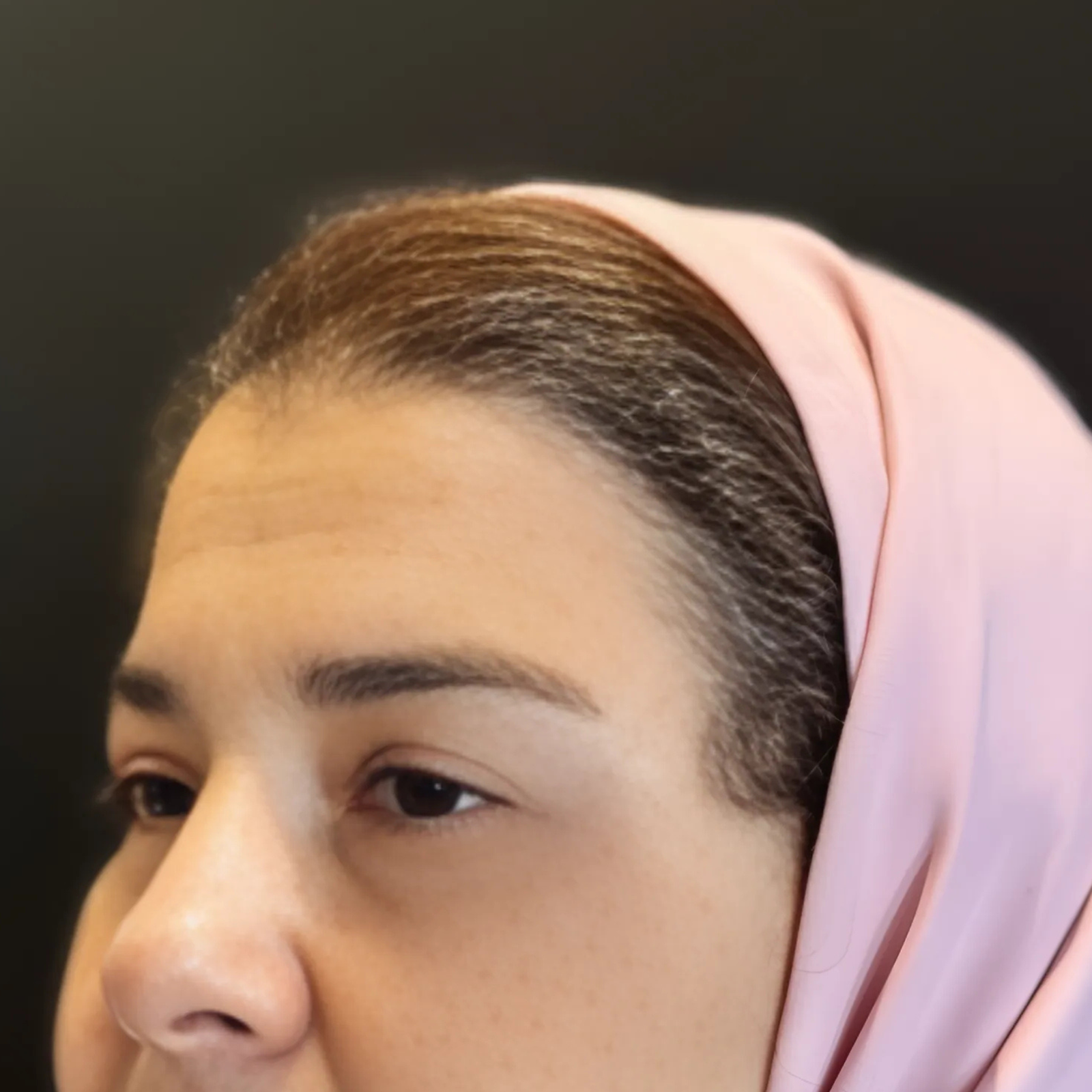 hcaesthetics- avant apres blepharoplastie superieur (1) hcaesthetics- avant apres blepharoplastie superieur (1)
