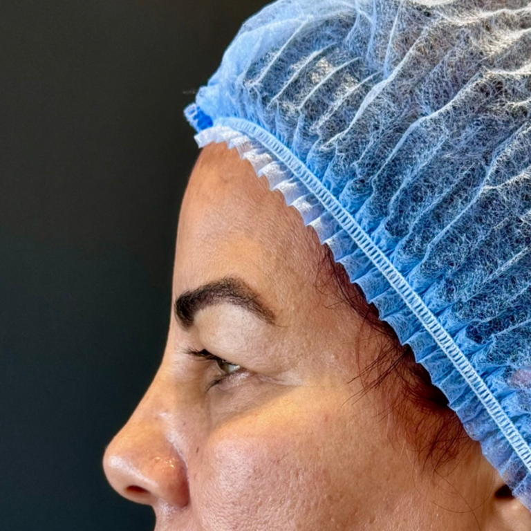 Chirurgie des paupières HC Aesthetics hcaesthetics- avant apres blepharoplastie superieur (4)