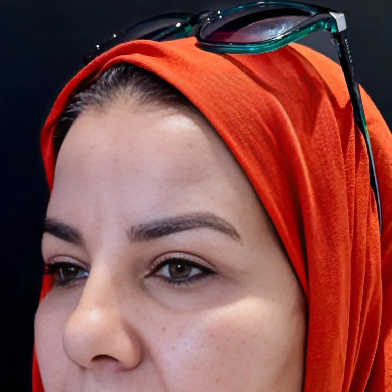 Chirurgie des paupières HC Aesthetics hcaesthetics- avant apres blepharoplastie superieur (5)