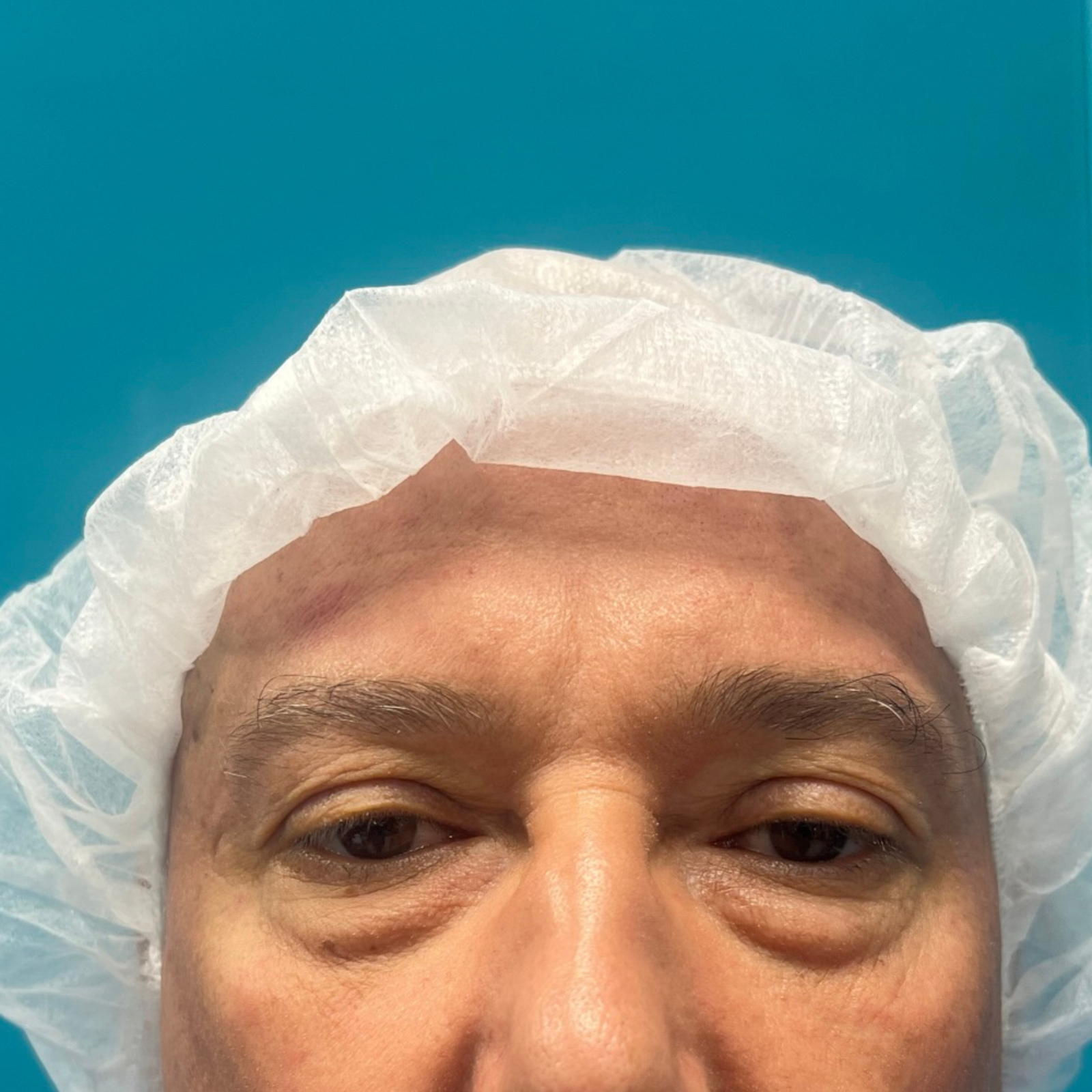 hcaesthetics- avant apres blepharoplastie superieur (8) hcaesthetics- avant apres blepharoplastie superieur (1)