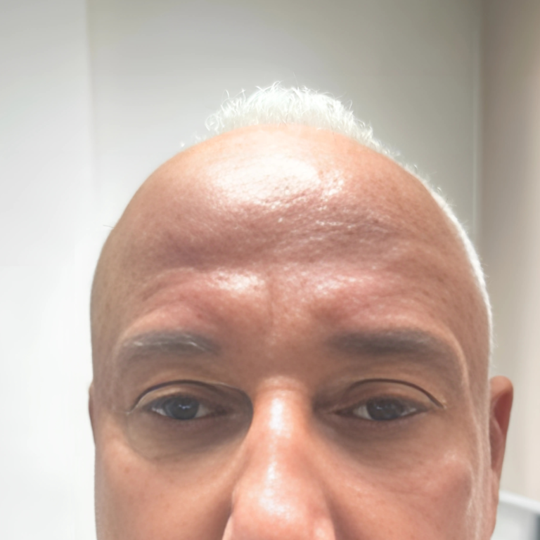 hcaesthetics- avant apres blepharoplastie superieur (9)