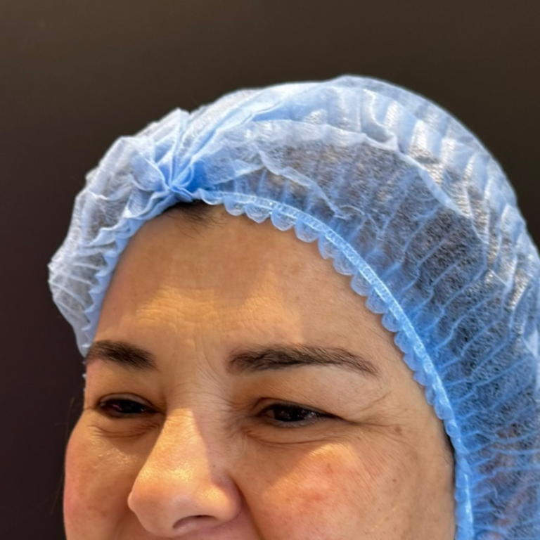 hcaesthetics- avant apres blepharoplastie superieur (2)