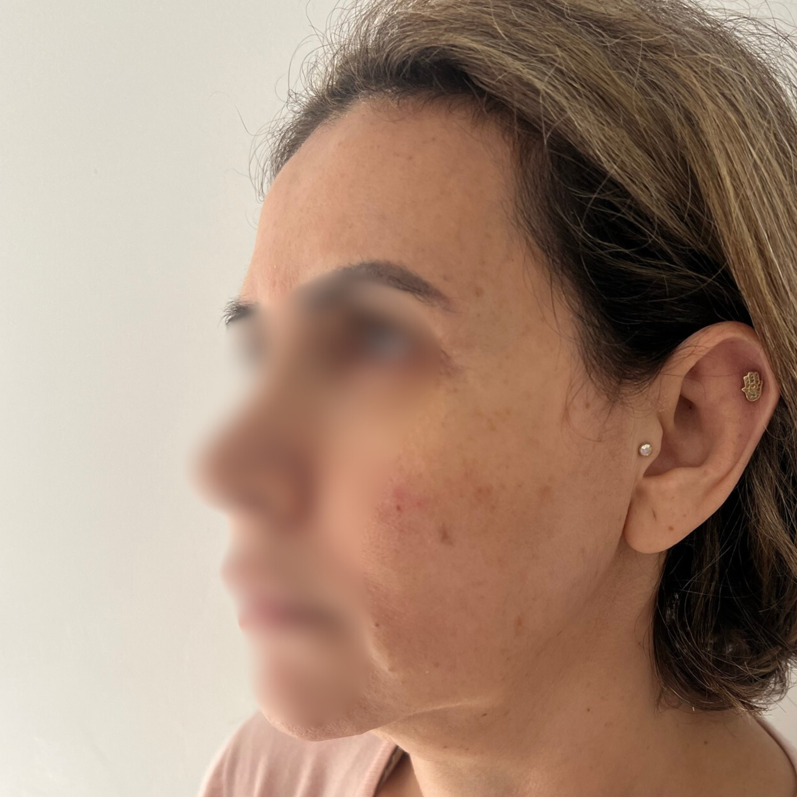 hcaesthetics- avant apres-lifting cervico-facial 1 hcaesthetics- avant apres-lifting cervico-facial 1