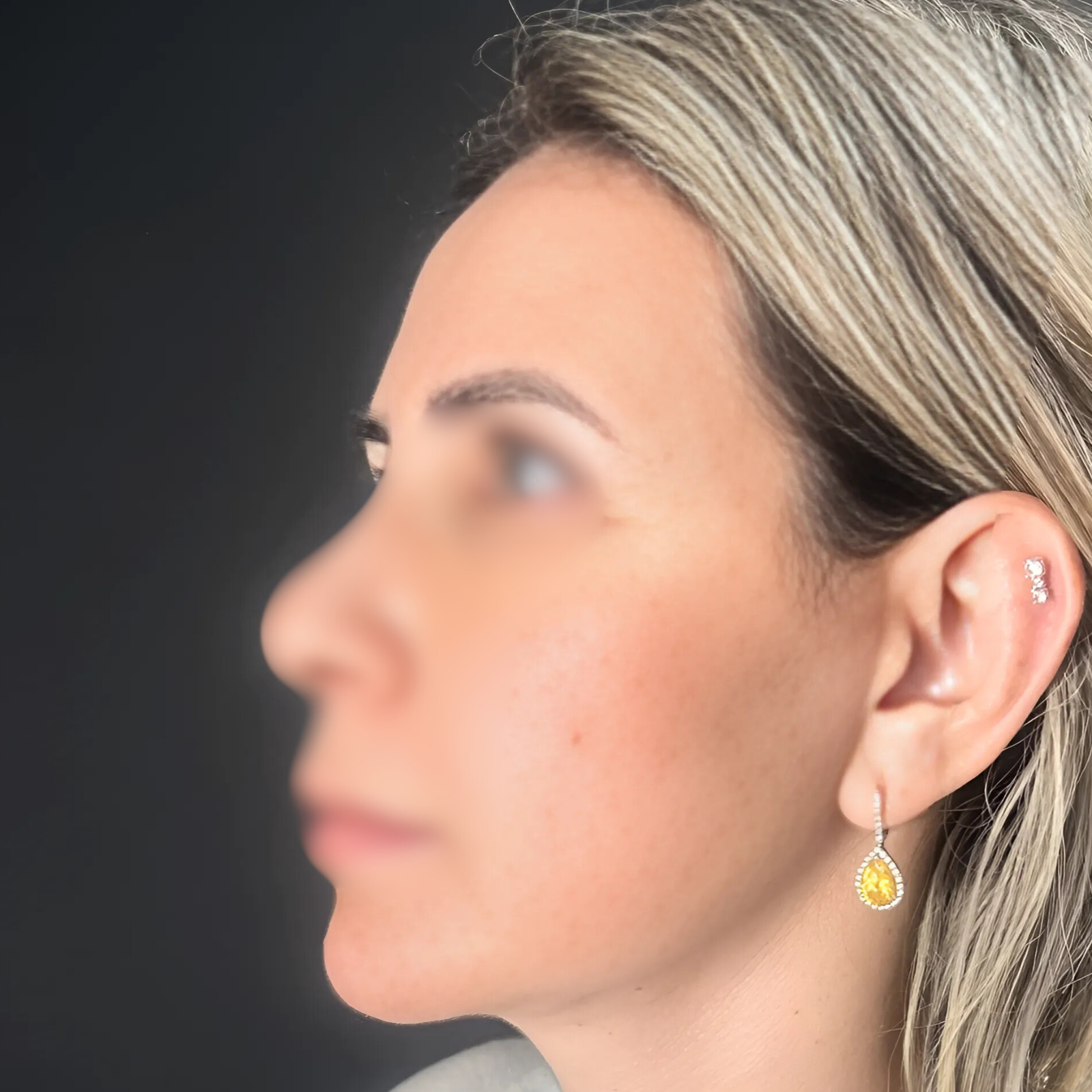 hcaesthetics- avant apres-lifting cervico-facial 1 hcaesthetics- avant apres-lifting cervico-facial 1