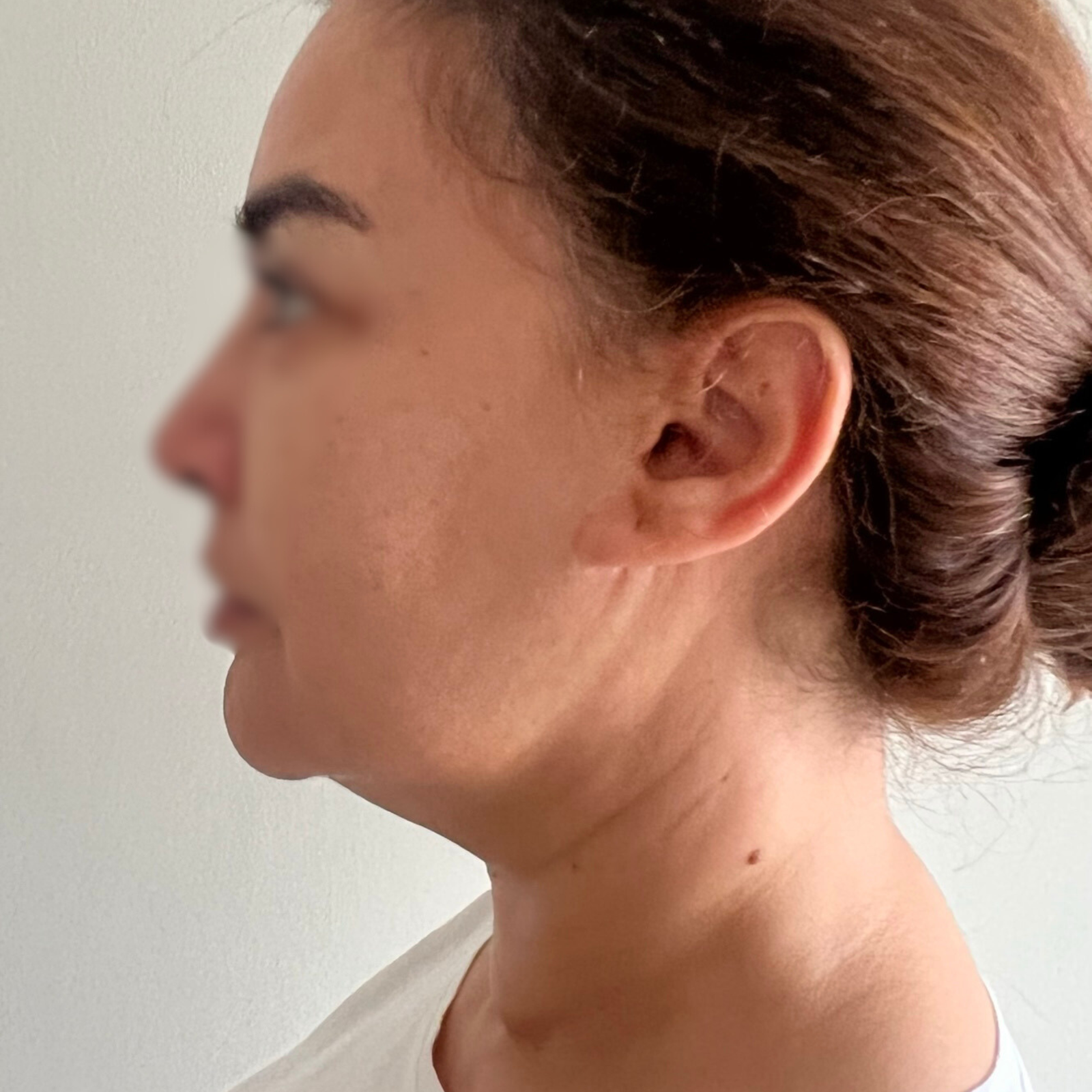 hcaesthetics- avant apres-lifting cervico-facial 3 hcaesthetics- avant apres-lifting cervico-facial