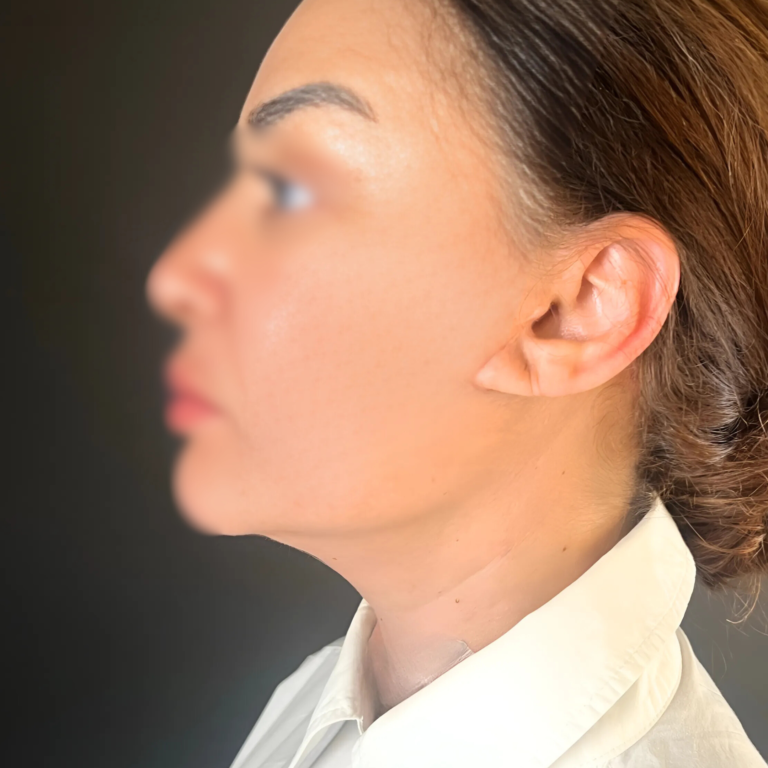 Lifting cervico-facial à Casablanca : Rajeunir le visage de façon naturelle HC Aesthetics hcaesthetics- avant apres-lifting cervico-facial 1