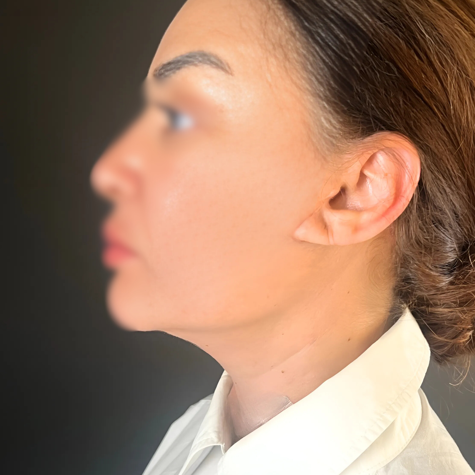 hcaesthetics- avant apres-lifting cervico-facial 4 hcaesthetics- avant apres-lifting cervico-facial 1