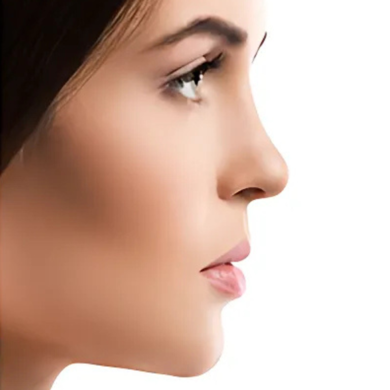 hcaesthetics- avant apres-rhinoplastie