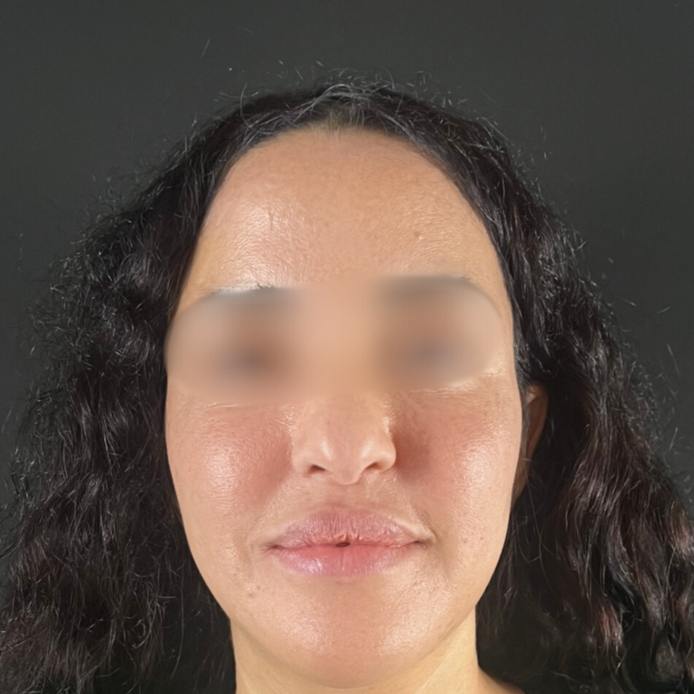 hcaesthetics- avant apres-rhinoplastie