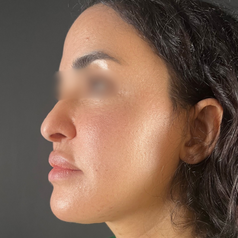 hcaesthetics- avant apres-rhinoplastie