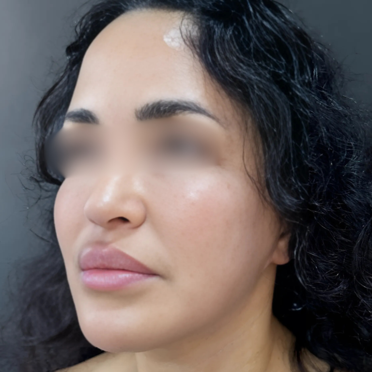 hcaesthetics- avant apres-rhinoplastie