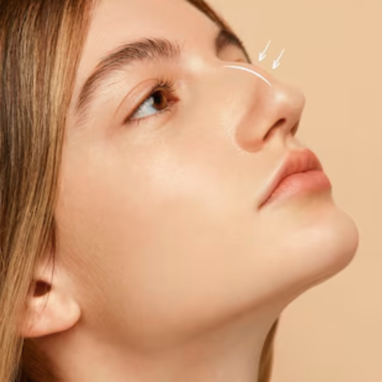 hcaesthetics- avant apres-rhinoplastie