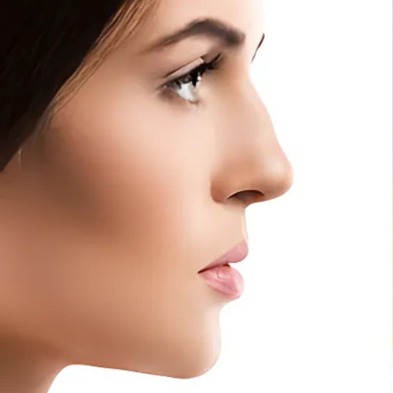 hcaesthetics- avant apres-rhinoplastie