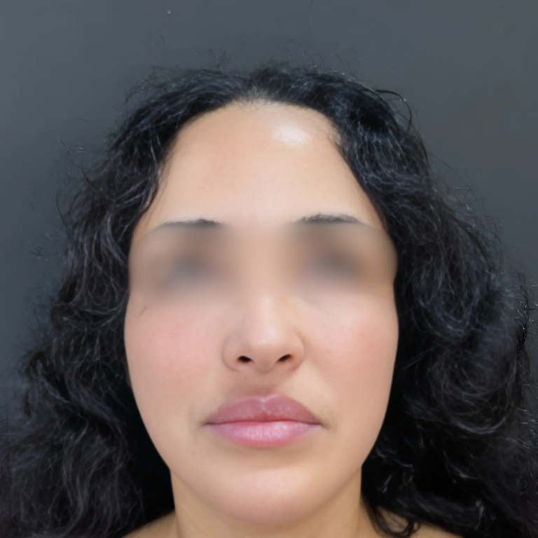 hcaesthetics- avant apres-rhinoplastie