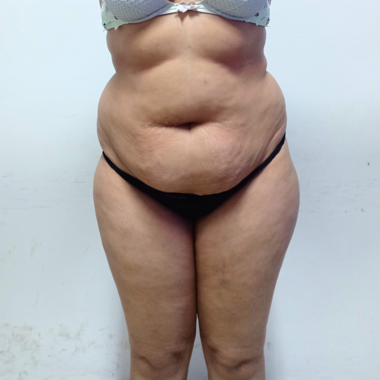 hcaesthetics- avant lipoabdominoplastie