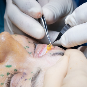 hcaesthetics blépharoplastie intervention