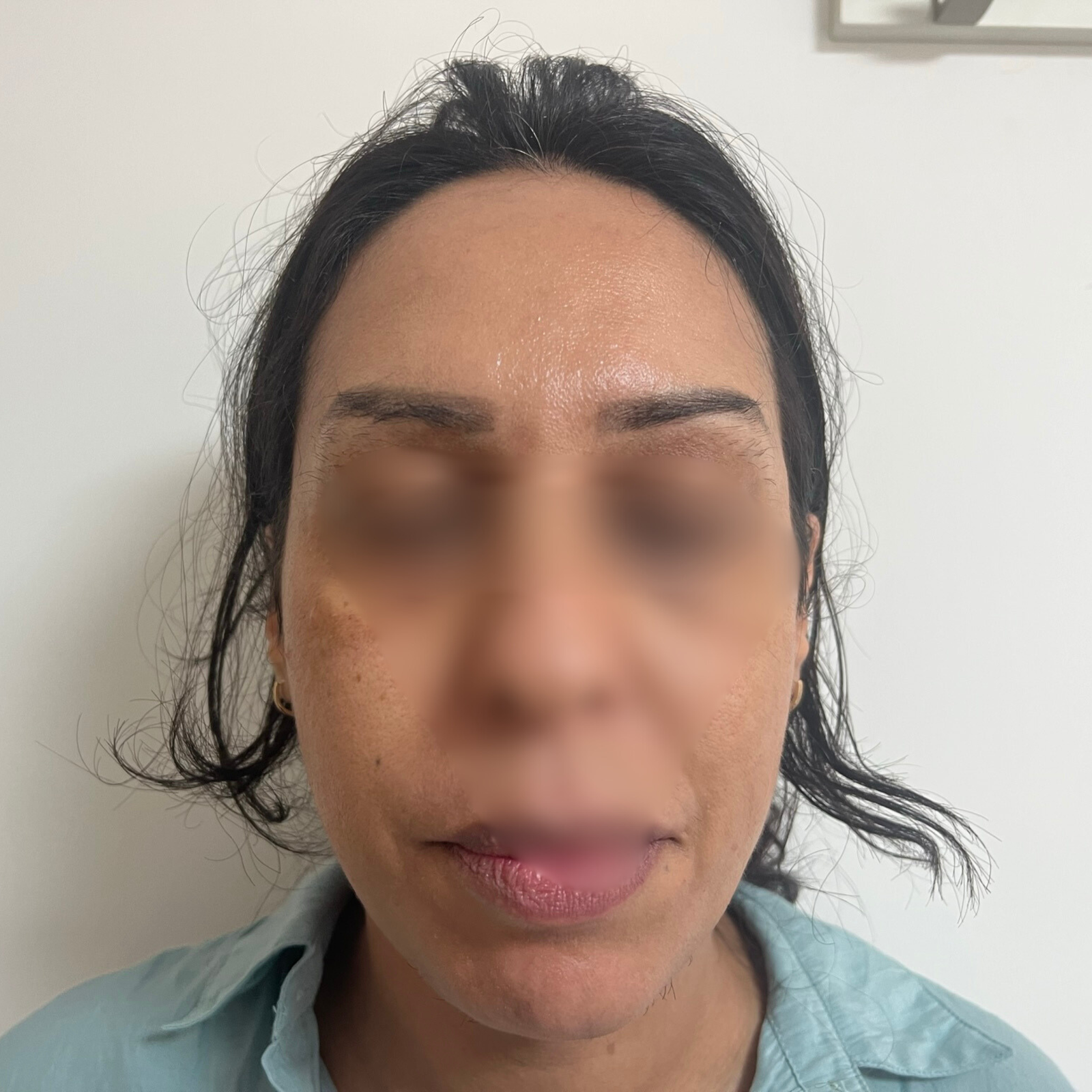 hc aesthetics-cabinet-lipofiling hc aesthetics-cabinet-lipofiling
