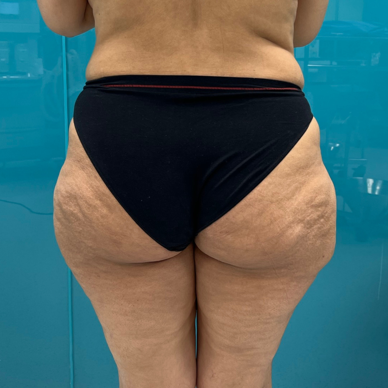 hc aesthetics-cabinet-lifting des cuisses