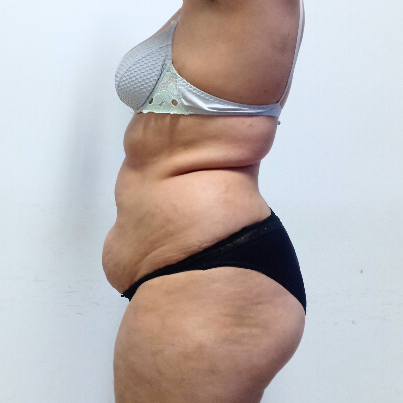 hcaesthetics- avant apres Abdominoplastie hcaesthetics- avant apres Abdominoplastie