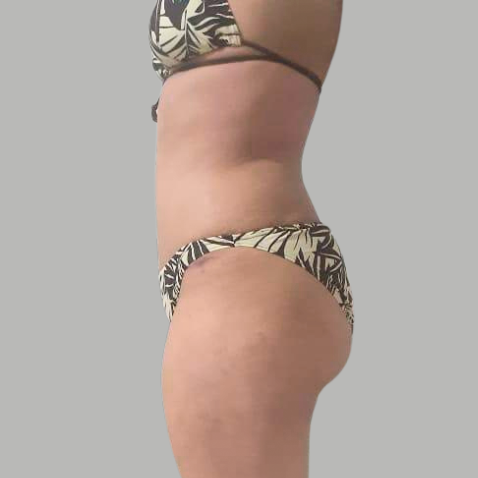 hcaesthetics- avant apres Abdominoplastie hcaesthetics- avant apres Abdominoplastie