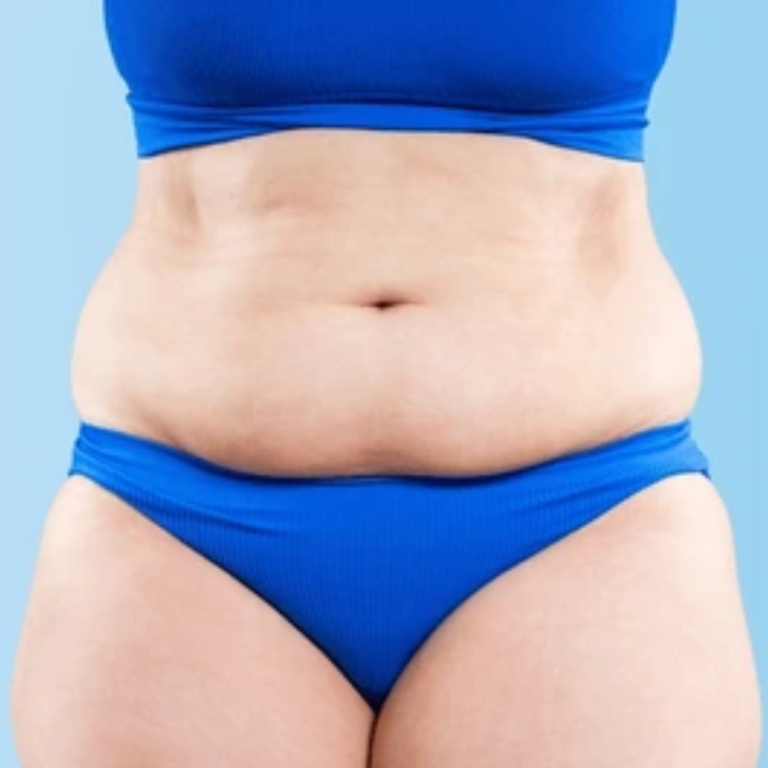 Résultats avant / après d’abdominoplastie à Casablanca