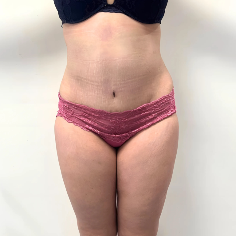 hcaesthetics- avant apres Abdominoplastie
