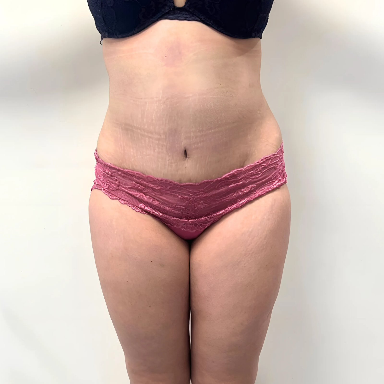 hcaesthetics- avant apres Abdominoplastie