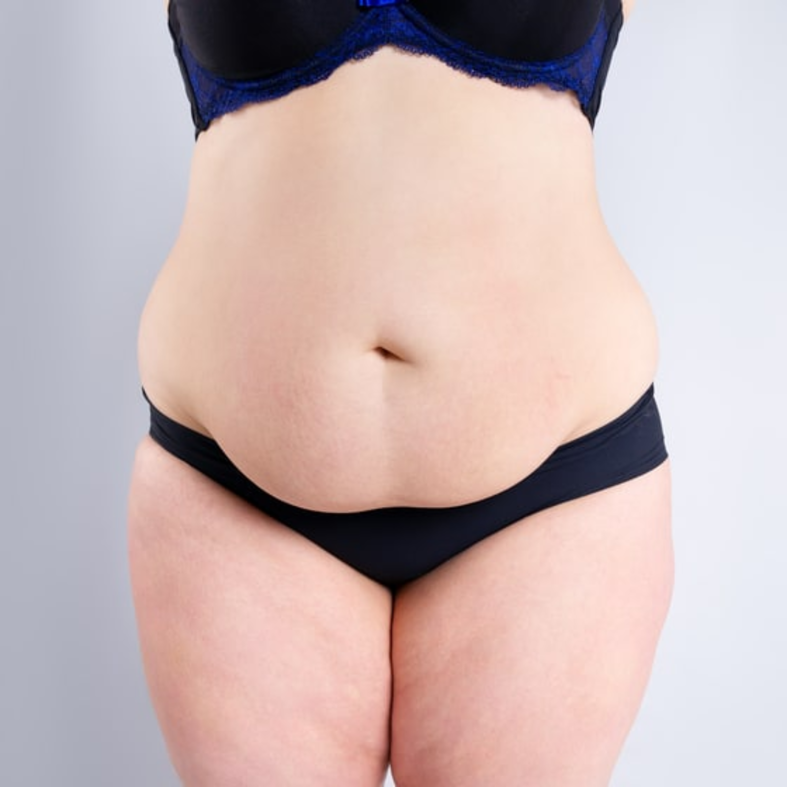 Résultats avant / après d’abdominoplastie à Casablanca Résultats avant / après d’abdominoplastie à Casablanca