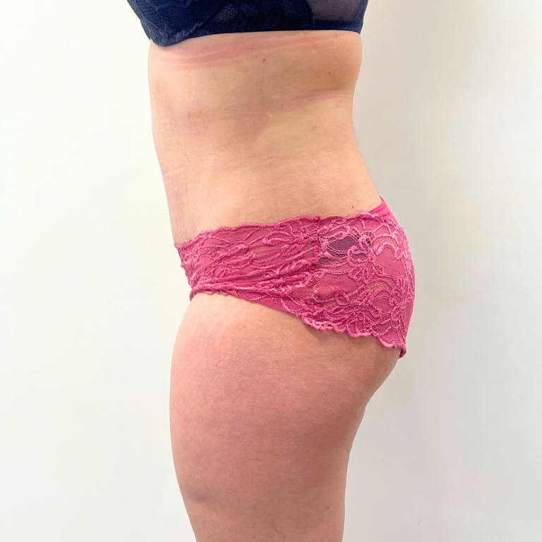 hcaesthetics- avant apres Abdominoplastie