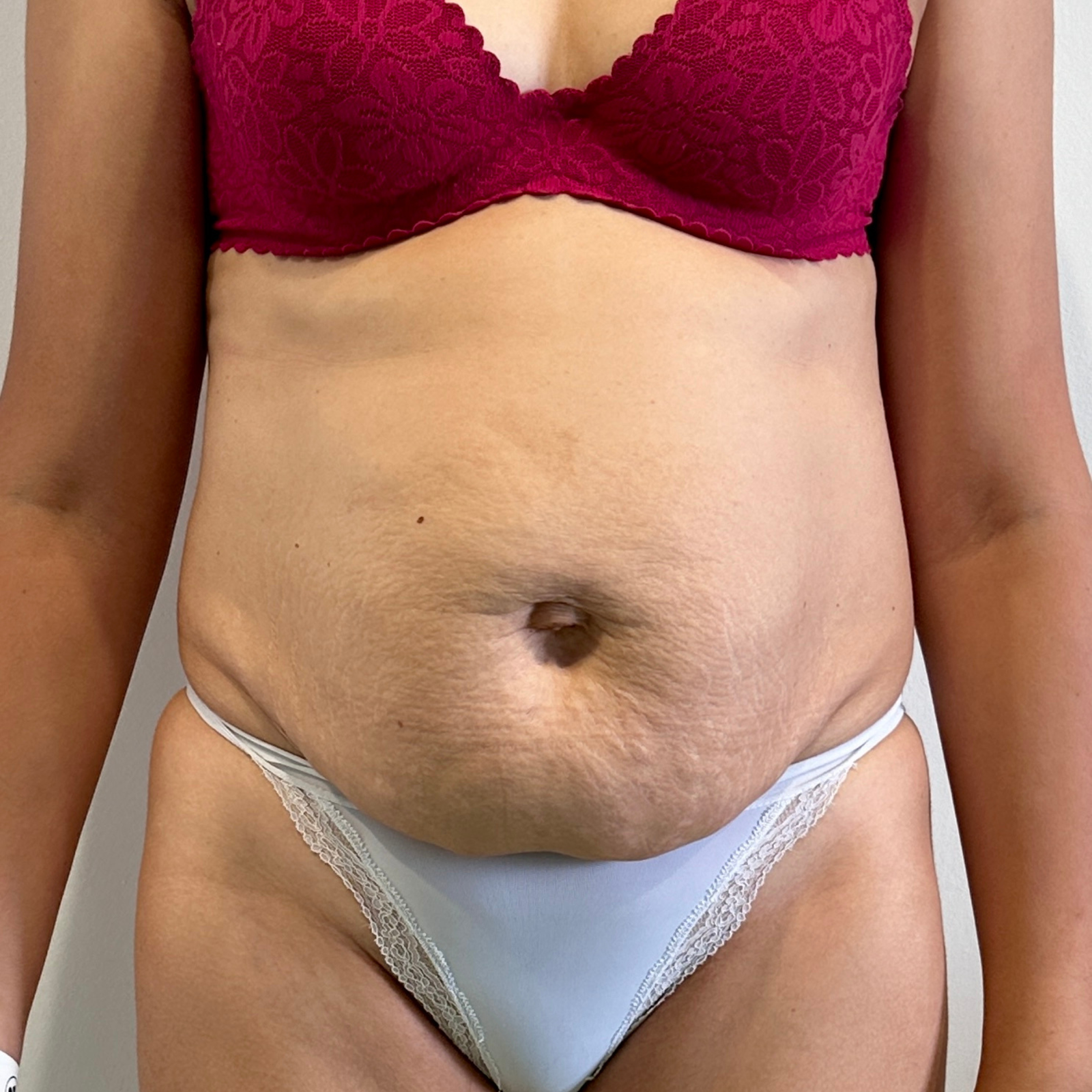 Résultats avant / après d’abdominoplastie à Casablanca