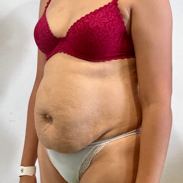 Résultats avant / après d’abdominoplastie à Casablanca