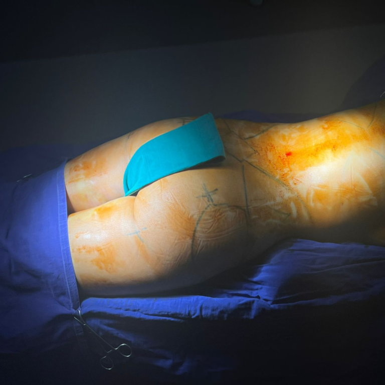 hc aesthetics-cabinet-BBL