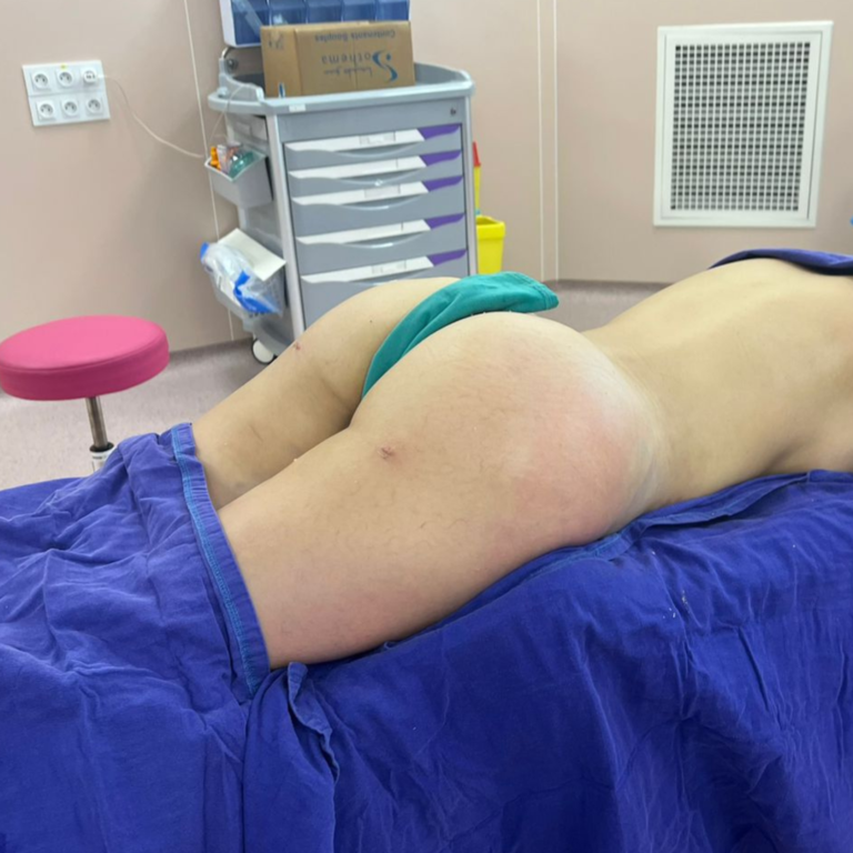 hc aesthetics-cabinet-BBL