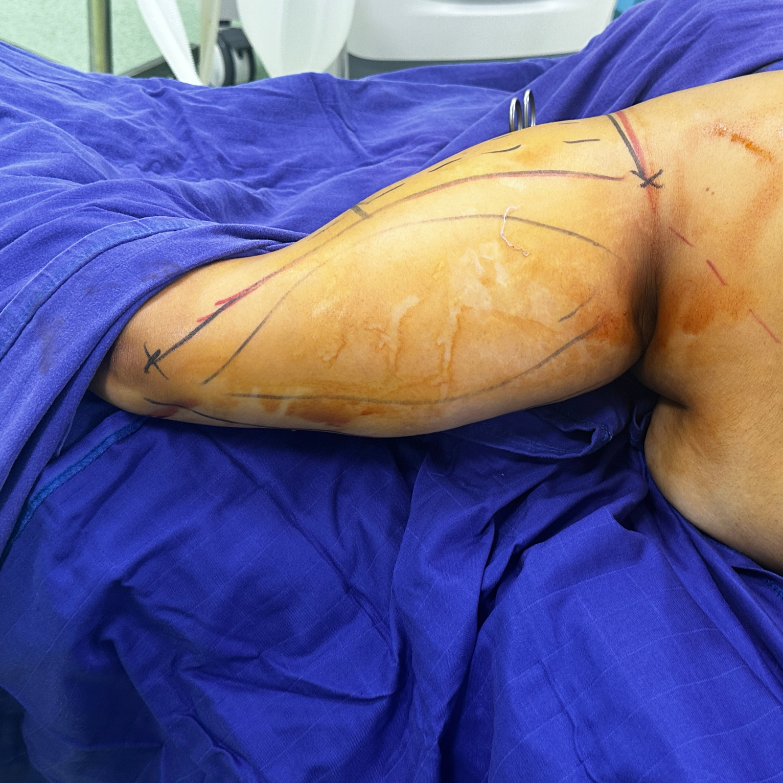 hcaesthetics- avant apres-brachioplastie (lifting des bras ) hcaesthetics- avant apres-brachioplastie (lifting des bras )