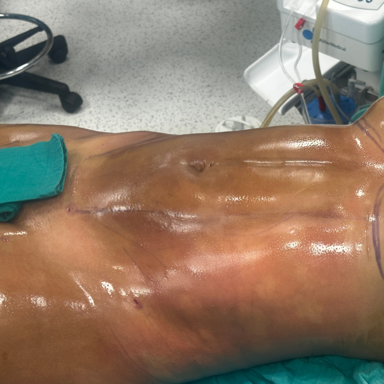 hc aesthetics-cabinet-Liposussion Avant Apres