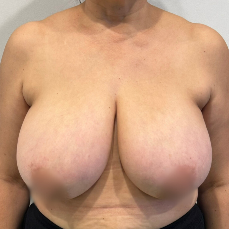 Réduction mammaire à Casablanca : bien plus qu’une chirurgie esthétique HC Aesthetics hc aesthetics-cabinet-reduction mammaire