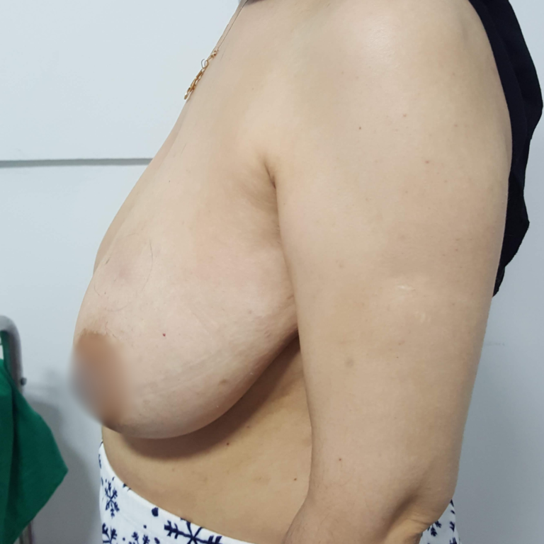 Réduction mammaire à Casablanca : bien plus qu’une chirurgie esthétique HC Aesthetics hc aesthetics-cabinet-reduction mammaire