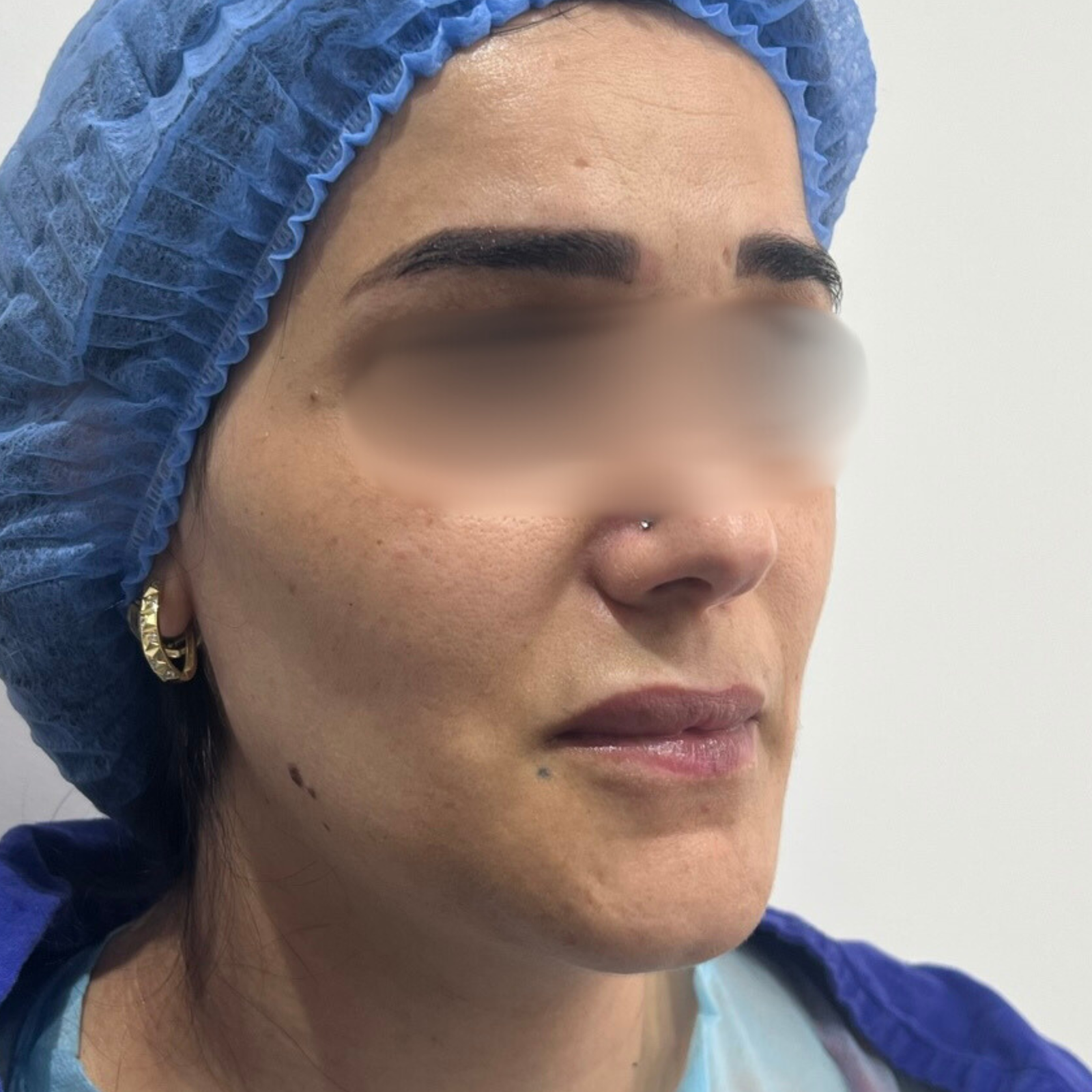 hc aesthetics-cabinet-lipofiling hc aesthetics-cabinet-lipofiling